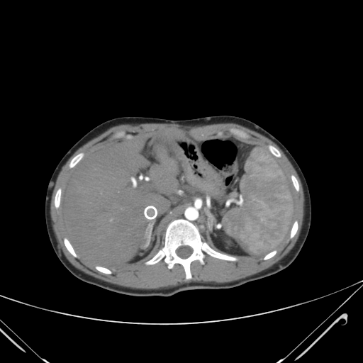 File:Nutmeg liver- Budd-Chiari syndrome (Radiopaedia 46234-50635 A 23).png