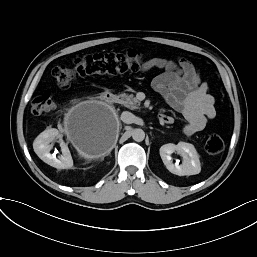 Obstructed upper pole ureter in a duplex kidney (Radiopaedia 54935-61221 Axial C+ delayed 13).jpg