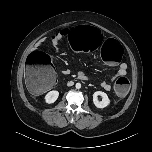 Obstructing sigmoid adenocarcinoma (Radiopaedia 58465-65619 A 78).jpg