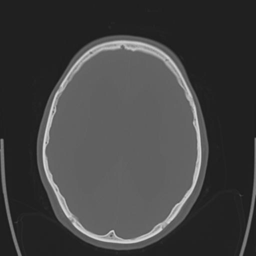 File:Obstructive hydrocephalus (Radiopaedia 30453-31119 Axial bone window 13).jpg