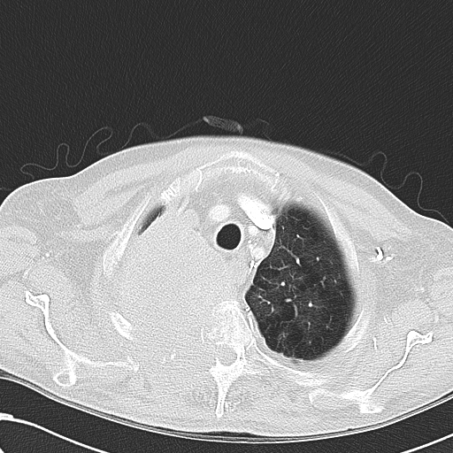 File:Obstructive superior vena cava tumor thrombus (Radiopaedia 28046-28306 Axial lung window 10).jpg