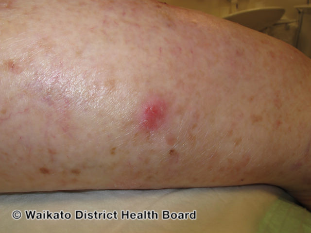 File:Superficial basal cell carcinoma, arm (DermNet NZ sbcc-arm-19-wdhb).jpg