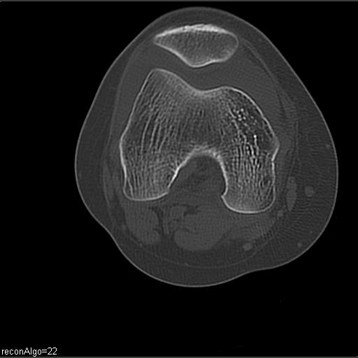 File:ACL avulsion fracture (Radiopaedia 33833-34994 Axial bone window 14).jpg