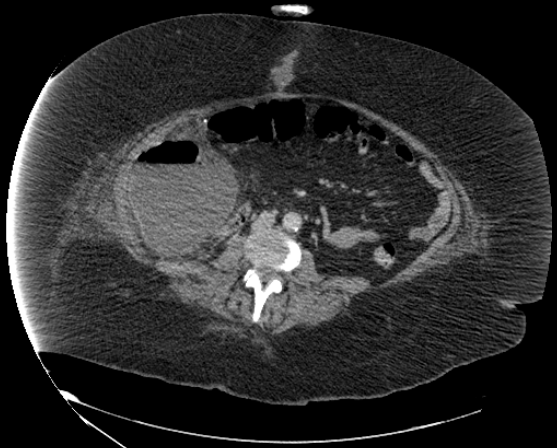 File:Abdominal abscess - pre and post percutaneous drainage (Radiopaedia 60209-67816 Axial 14).png