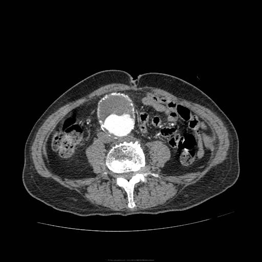 Abdominal aortic aneurysm (Radiopaedia 13341-13340 Axial C+ arterial phase 131).jpg