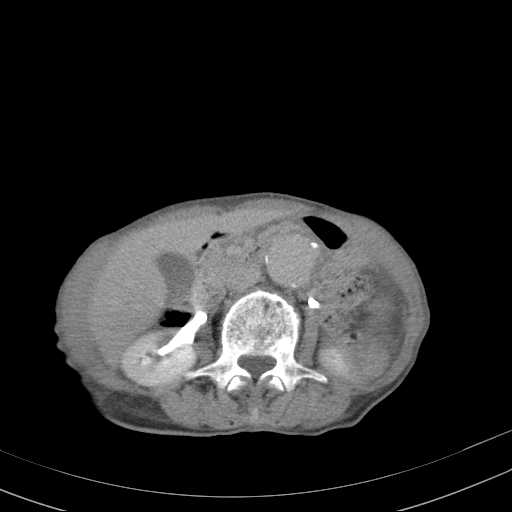 File:Abdominal aortic aneurysm (Radiopaedia 20827-20742 Axial C+ delayed 14).jpg