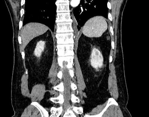 Abdominal aortic aneurysm (Radiopaedia 67117-76452 Coronal C+ arterial phase 83).jpg