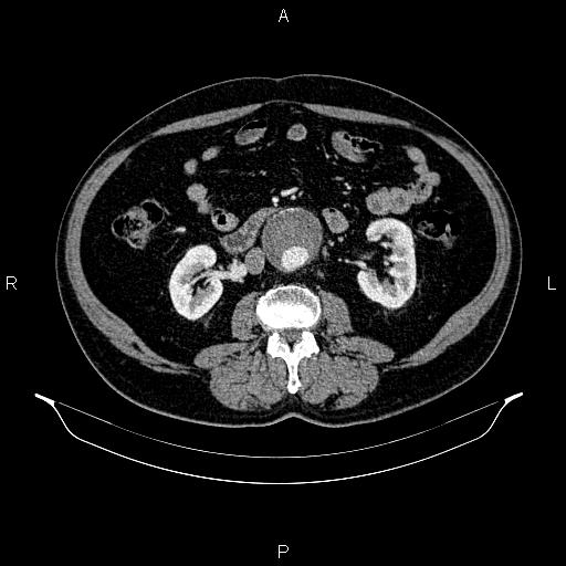 Abdominal aortic aneurysm (Radiopaedia 83094-97462 Axial renal cortical phase 99).jpg
