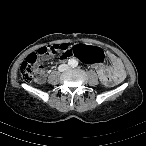Abdominal aortic aneurysm (Radiopaedia 83581-98689 Axial C+ portal venous phase 69).jpg