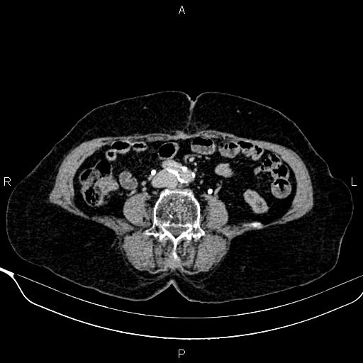 File:Abdominal aortic aneurysm (Radiopaedia 85063-100606 Axial C+ delayed 81).jpg