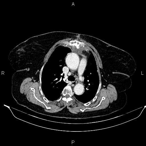 File:Abdominal aortic aneurysm (Radiopaedia 85063-100606 Axial C+ portal venous phase 14).jpg