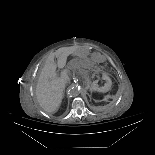 Abdominal aortic aneurysm - impending rupture (Radiopaedia 19233-19247 Axial non-contrast 54).jpg