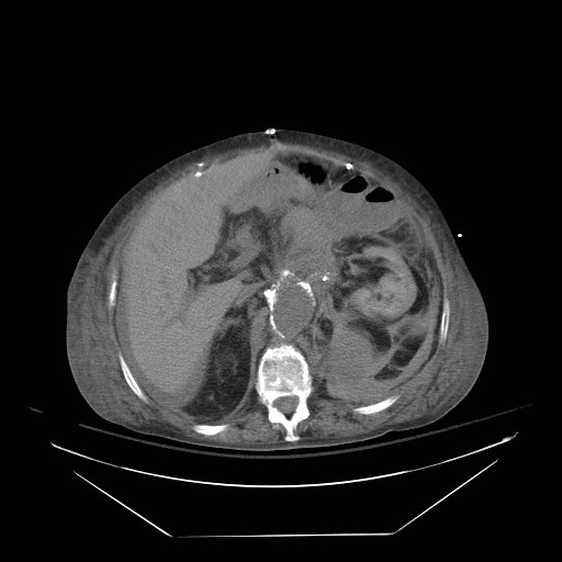 Abdominal aortic aneurysm - impending rupture (Radiopaedia 19233-19247 Axial non-contrast 61).jpg