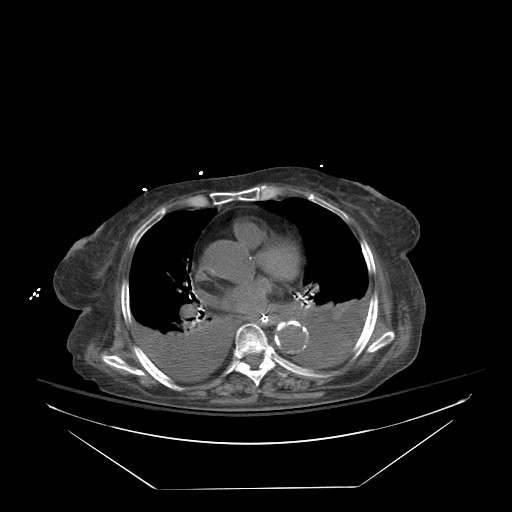 Abdominal aortic aneurysm - impending rupture (Radiopaedia 19233-19247 Axial non-contrast 7).jpg