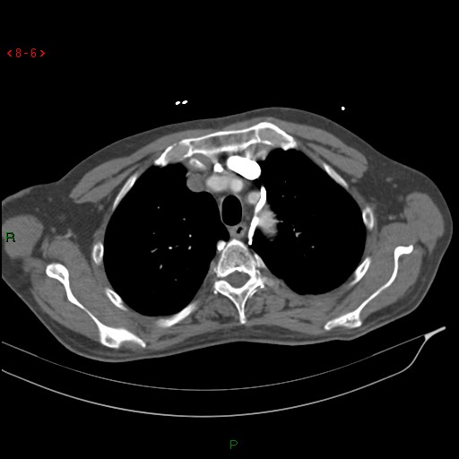 Abdominal aortic aneurysm rupture with aortocaval fistula (Radiopaedia 14897-14841 Axial C+ arterial phase 6).jpg