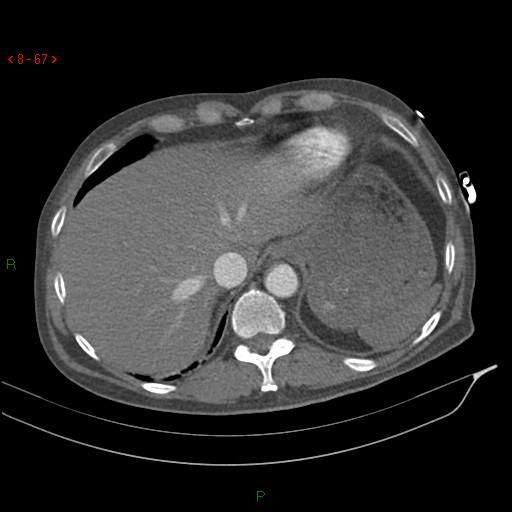 Abdominal aortic aneurysm rupture with aortocaval fistula (Radiopaedia 14897-14841 Axial C+ arterial phase 67).jpg