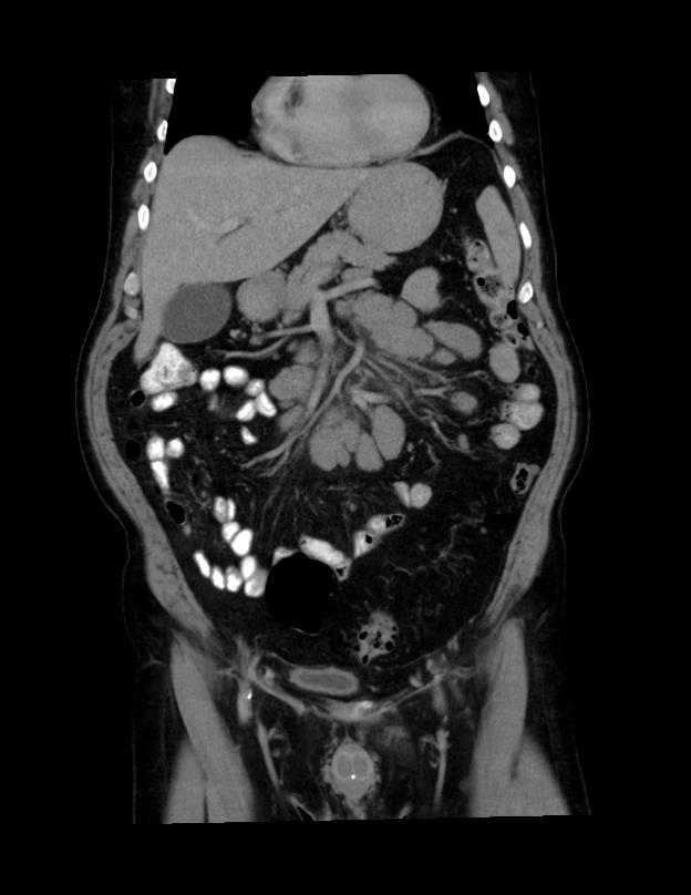 Abdominal lymphoma - with sandwich sign (Radiopaedia 53486-59492 C+ portal venous phase 39).jpg