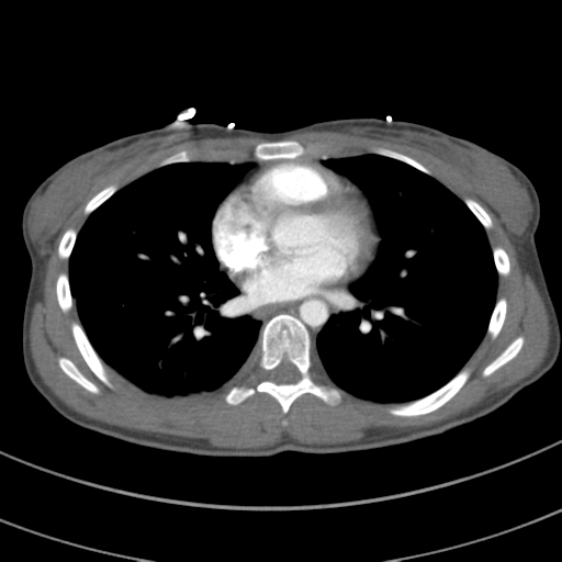 File:Abdominal multi-trauma - devascularised kidney and liver, spleen and pancreatic lacerations (Radiopaedia 34984-36486 Axial C+ arterial phase 49).png