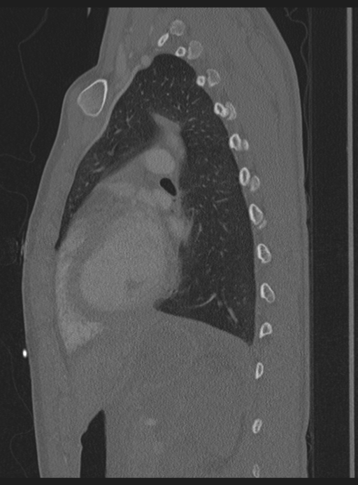 Abdominal multi-trauma - devascularised kidney and liver, spleen and pancreatic lacerations (Radiopaedia 34984-36486 Sagittal bone window 14).png