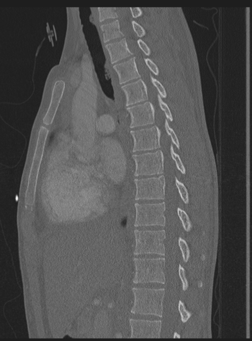 Abdominal multi-trauma - devascularised kidney and liver, spleen and pancreatic lacerations (Radiopaedia 34984-36486 Sagittal bone window 37).png