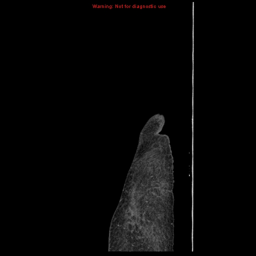 Abdominal wall hematoma (Radiopaedia 9427-10112 Sagittal C+ portal venous phase 1).jpg