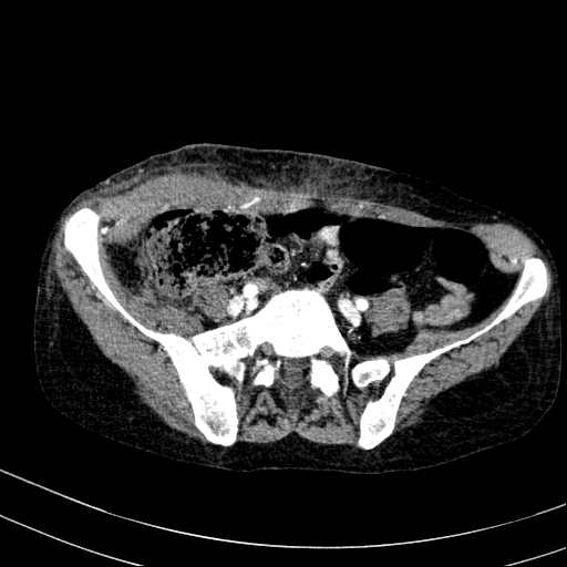 Abdominal wall hematoma with active bleeding (Radiopaedia 83915-99117 Axial renal cortical phase 91).jpg