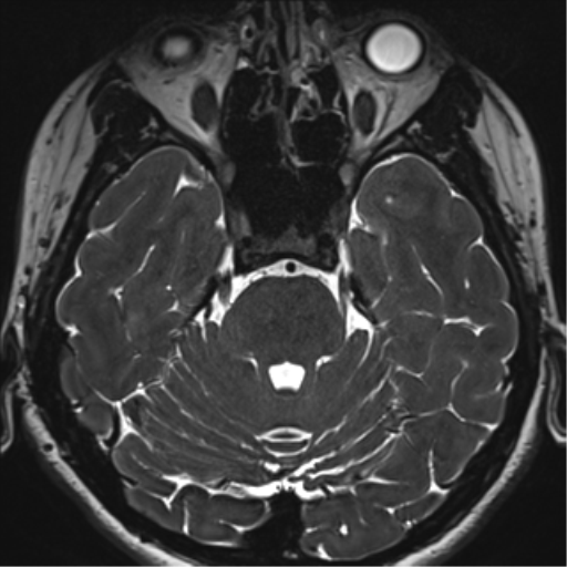 Abducens nerve palsy (Radiopaedia 51069-56648 Axial T2 fat sat 39).png
