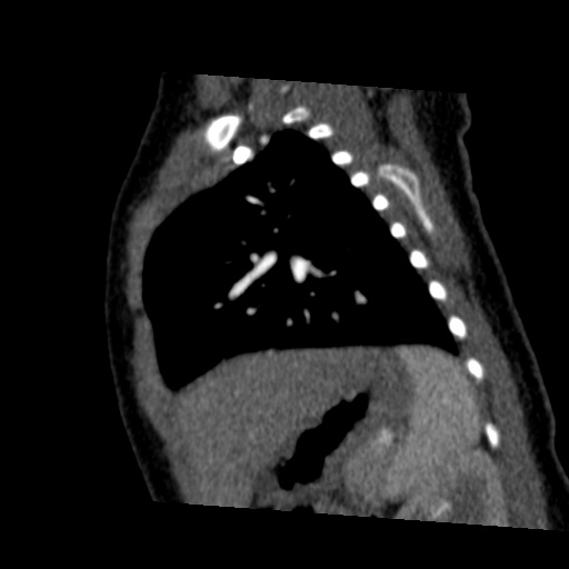 Aberrant left pulmonary artery (pulmonary sling) (Radiopaedia 42323-45435 Sagittal C+ arterial phase 40).jpg