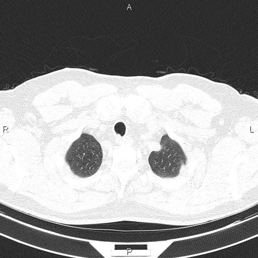 Aberrant right subclavian artery (Radiopaedia 87093-103354 Axial lung window 14).jpg