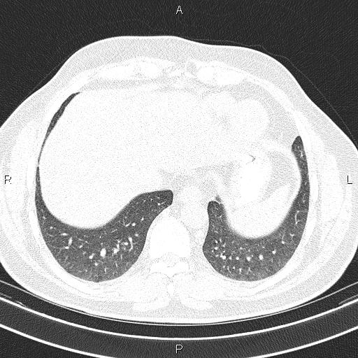 Aberrant right subclavian artery (Radiopaedia 87093-103354 Axial lung window 88).jpg
