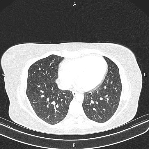 Aberrant right subclavian artery (Radiopaedia 87334-103629 Axial lung window 45).jpg