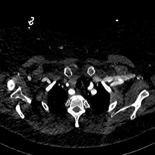Aberrant right subclavian artery with Kommerell diverticulum (Radiopaedia 47982-52769 Axial C+ arterial phase 14).png