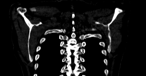 Accesory rib joint (Radiopaedia 71987-82452 Coronal bone window 70).jpg