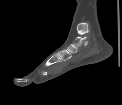 File:Accessory navicular bone (Radiopaedia 54999-61314 Sagittal non-contrast 40).jpg