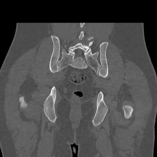 Acetabular and ilial fractures (Radiopaedia 59084-66378 Coronal bone window 41).jpg