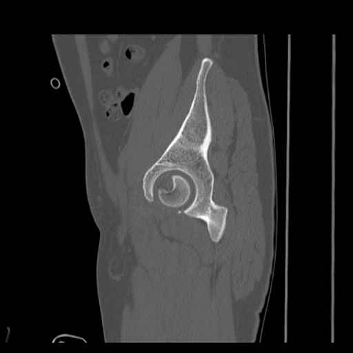 Acetabular and ilial fractures (Radiopaedia 59084-66378 Sagittal bone window 29).jpg