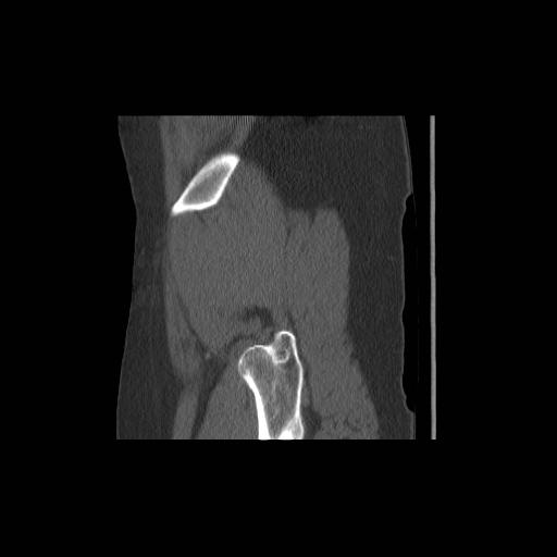 File:Acetabular fracture (Radiopaedia 13193-13212 Sagittal bone window 8).jpg