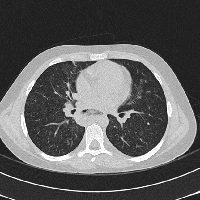 Achalasia (Radiopaedia 14946-14878 Axial lung window 40).jpg