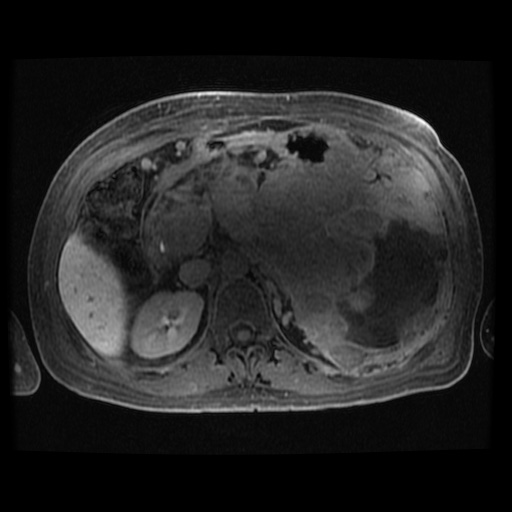 Acinar cell carcinoma of the pancreas (Radiopaedia 75442-86668 Axial late phase (~30 mins) 63).jpg