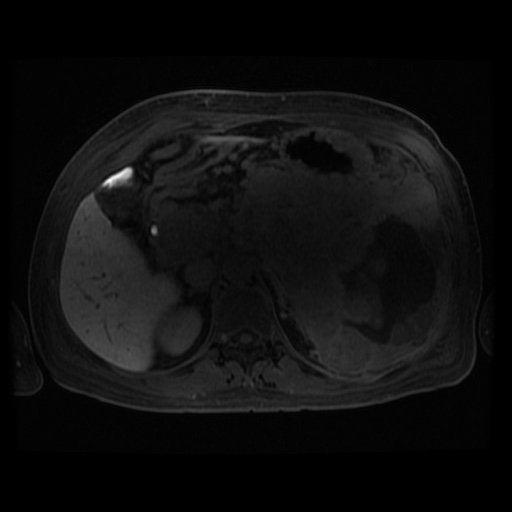 Acinar cell carcinoma of the pancreas (Radiopaedia 75442-86668 Axial late phase (~30 mins) 73).jpg