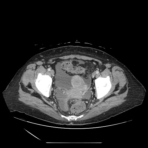 Acinar cell carcinoma of the pancreas (Radiopaedia 75442-86669 Axial C+ portal venous phase 132).jpg