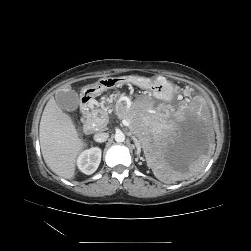 Acinar cell carcinoma of the pancreas (Radiopaedia 75442-86669 Axial C+ portal venous phase 47).jpg