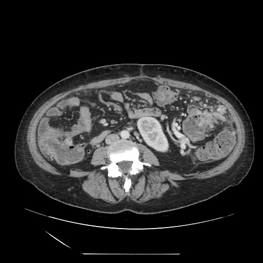 Acinar cell carcinoma of the pancreas (Radiopaedia 75442-86669 Axial C+ portal venous phase 84).jpg