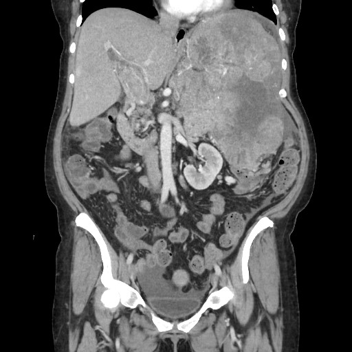 Acinar cell carcinoma of the pancreas (Radiopaedia 75442-86669 Coronal C+ portal venous phase 61).jpg