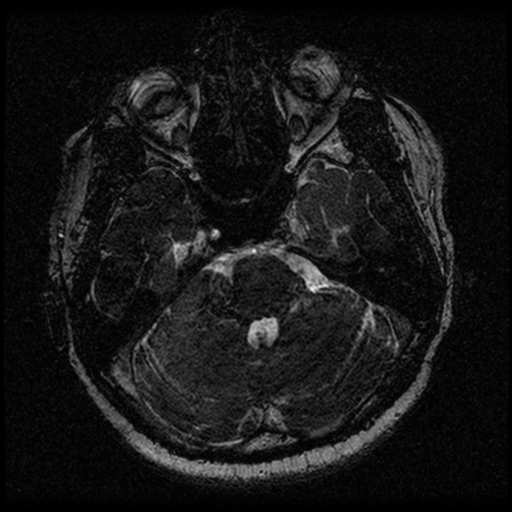 Acoustic schwannoma (Radiopaedia 33045-34060 Axial T2 40).png