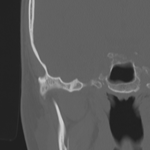 Acoustic schwannoma - eroding petrous apex (Radiopaedia 39674-42002 Coronal bone window 32).png