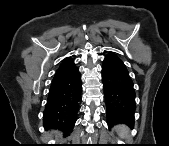 Acromioclavicular joint cyst (Radiopaedia 58455-65610 Coronal C+ arterial phase 117).jpg