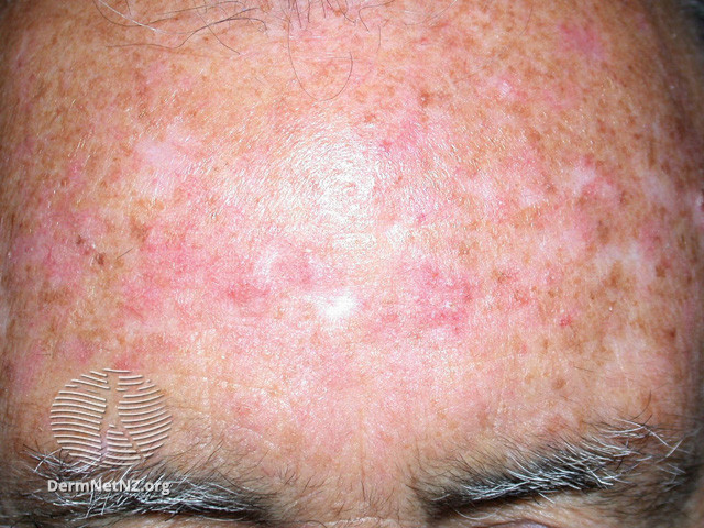 Actinic Keratoses treated with imiquimod (DermNet NZ lesions-ak-imiquimod-3751).jpg
