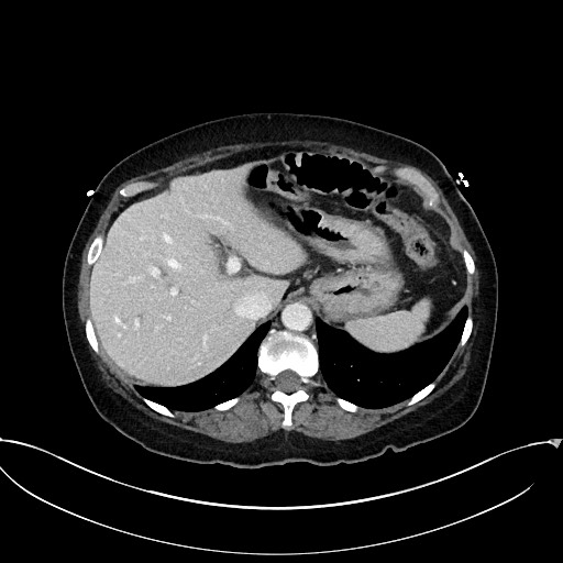 Active Crohn disease (Radiopaedia 59394-66750 Axial C+ portal venous phase 16).jpg