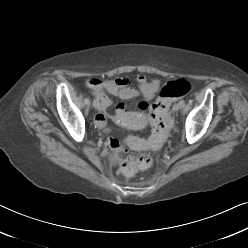 Active bleeding from duodenal ulcer with embolization (Radiopaedia 34216-35481 Axial non-contrast 57).png